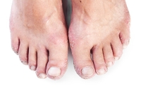 Understanding How Psoriatic Arthritis Affects the Feet