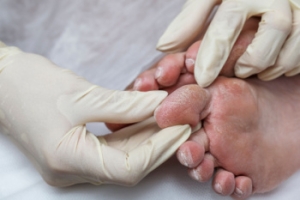 Diabetes and Foot Complications