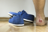 Diabetic Foot Blisters