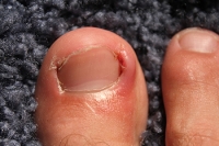 Ingrown Toenails and How to Treat Them
