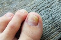 The Risk of Getting Toenail Fungus