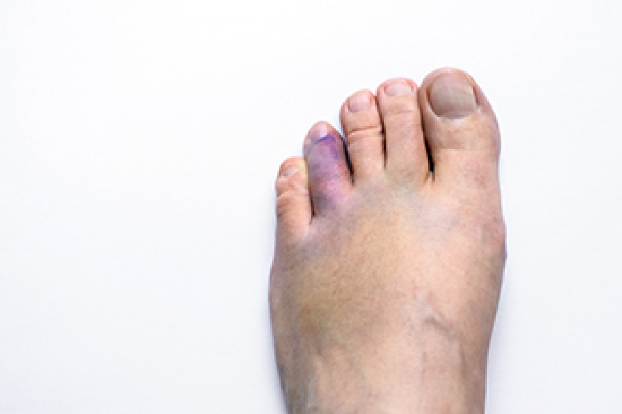 Summer Hack: Quick Fix for Ugly Toenails: Central Massachusetts Podiatry:  Podiatrists