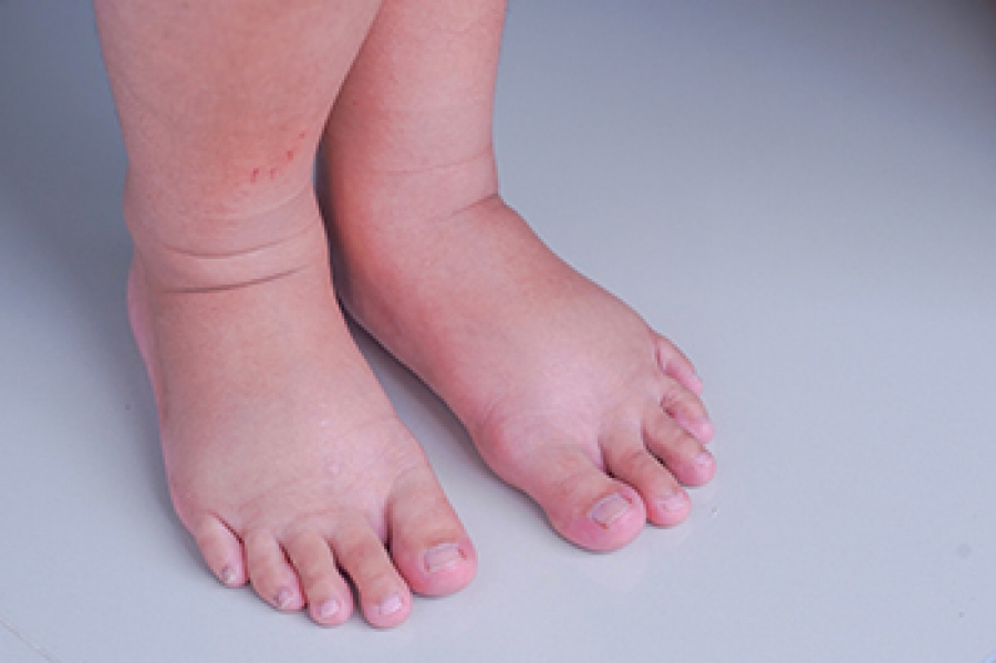 Swollen Feet May Be Linked to Eating Certain Foods