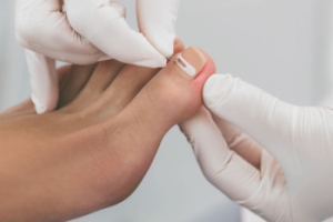 Facts About Ingrown Toenail Surgery