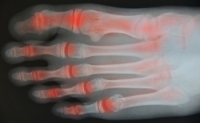 Ankle Arthritis Can Cause Severe Pain