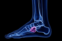 A Sudden Injury or Gradual Onset May Cause Cuboid Syndrome